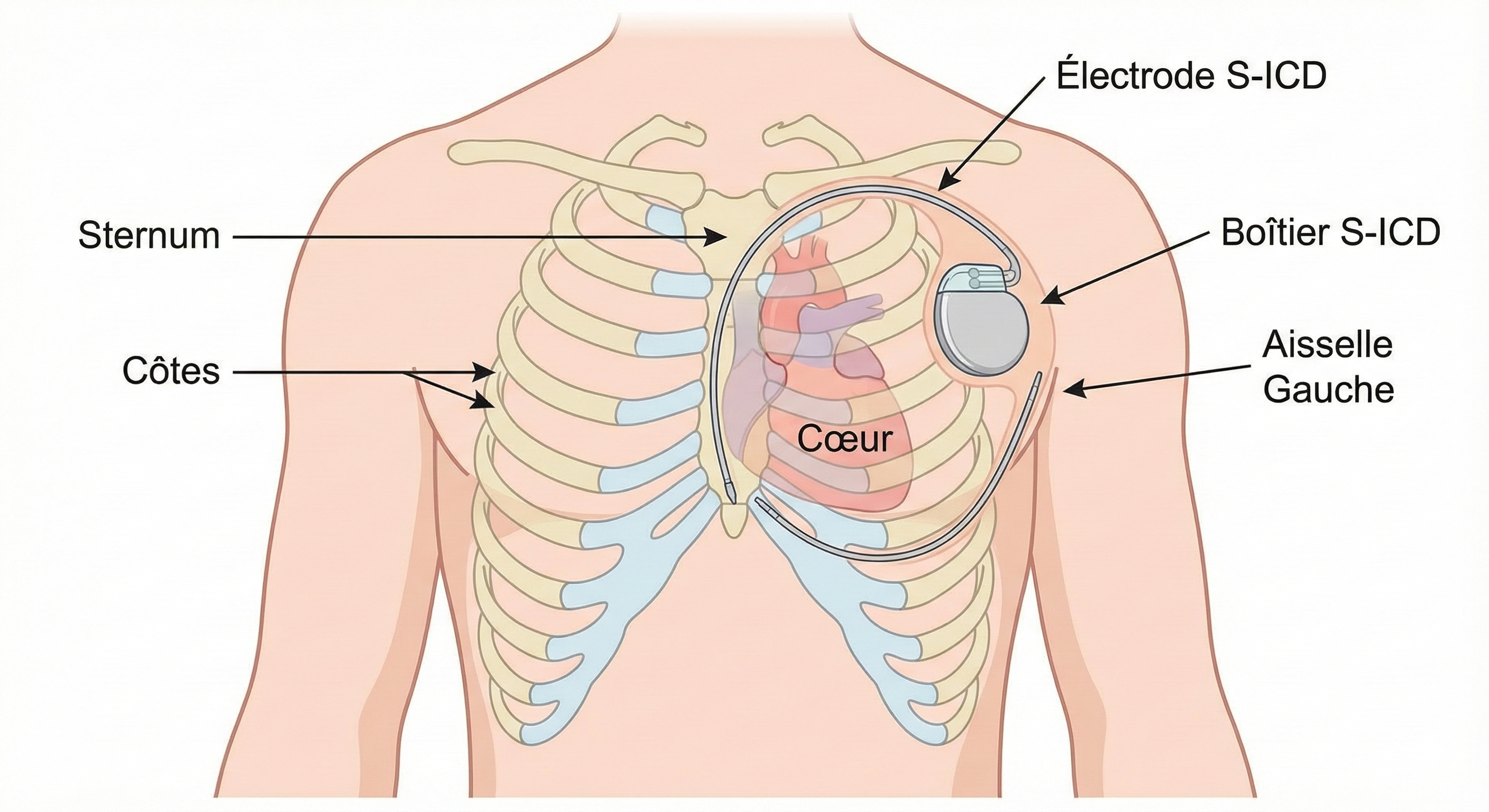 Schéma anatomique d'un défibrillateur sous-cutané S-ICD montrant le boîtier placé sous l'aisselle gauche et l'électrode le long du sternum